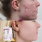 Сыворотка RtopR с прополисом для восстановления акне, осветляющая сыворотка для угрей, рубцов, очищающая Сыворотка для сужения пор, устраняет акне, контроль жирности кожи