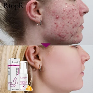 Сыворотка RtopR с прополисом для восстановления акне, осветляющая сыворотка для угрей, рубцов, очищающая Сыворотка для сужения пор, устраняет акне, контроль жирности кожи