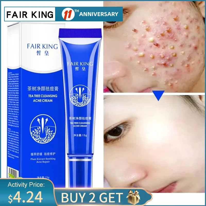 

Remova Anti Acne Whitening Face Cream Deep Cleaning Acne Scar Shrink Pores Treatment Facial Skin Care Cream Blackhead Repair