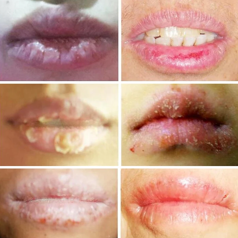 Natural Herbal Cold Sores Lip Treatment Cream Repair Anti Wrinkles Dry Chapped Moisturizing Oil |