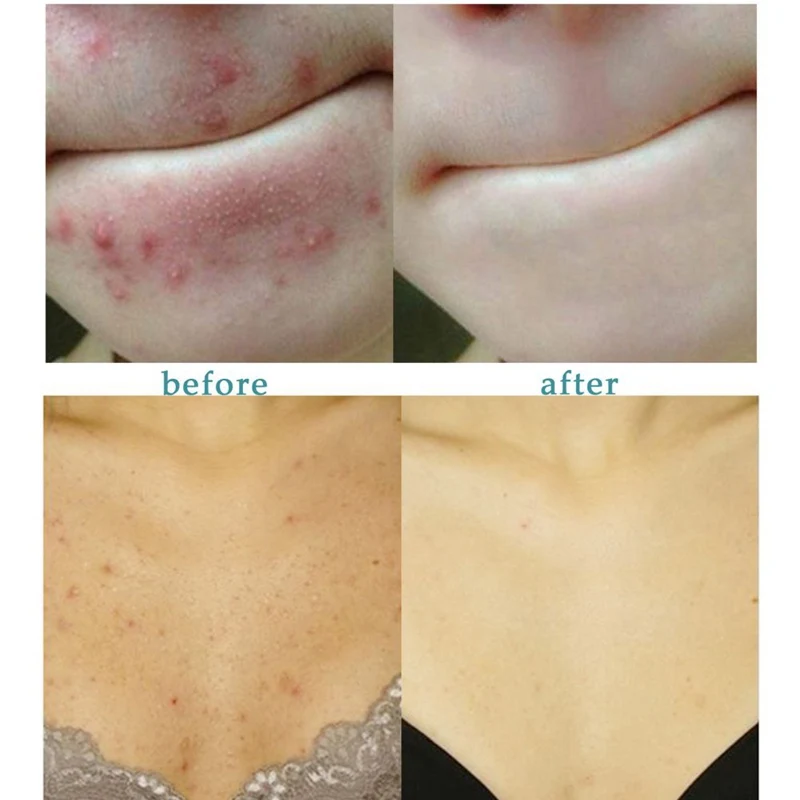 Эффективное восстанавливающее клещи питает кожу лица очищающее мыло против