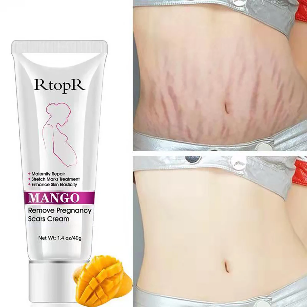 Treatment Stretch Mark Cream Fade Obesity Lines Promote Cell Regeneration Enhance Skin Elasticity Pregnant Women Postpartum Care | Красота и