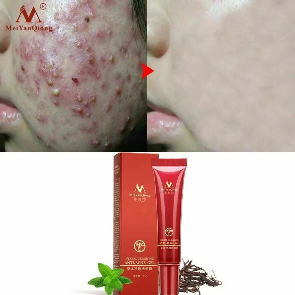 15 мл уход за кожей лица акне очищающий крем по уходу для удаления ремонт