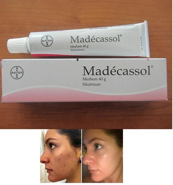 

Madecassol 40 г, сикатризан, ожоги, травма шрамов, удаление морщин от акне, растяжки, центелла азиатская