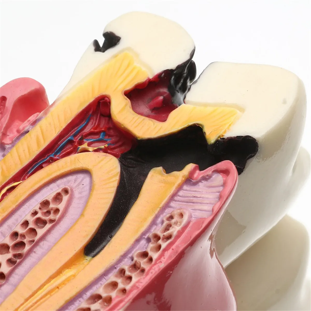 Новинка 1 шт. 6X протеза модель кариеса сравнительная Стоматолог патологий для