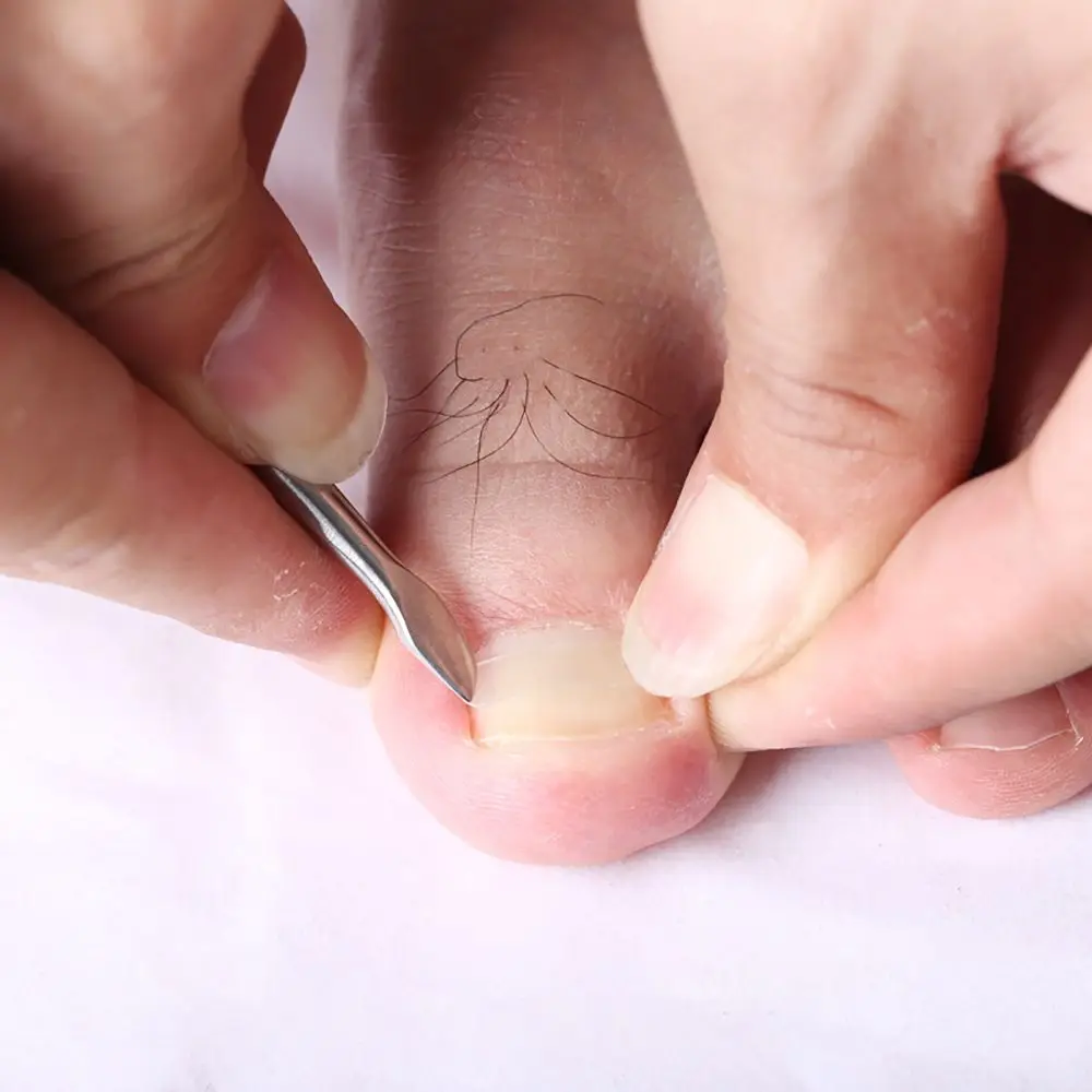 10pcs Ingrown Toe Nail Corrector Parches Stickers Paronychia Correction Treatment Elastic Sticker Foot Care Tools