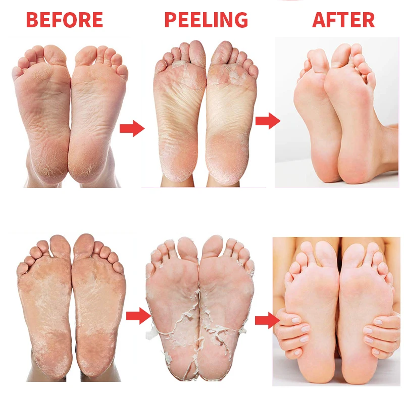 

EFERO 6Pair Exfoliating Foot Mask Scrub Feet Care Patches Socks for Pedicure Socks Feet Peeling Mask Removes Calluses Dead Skin