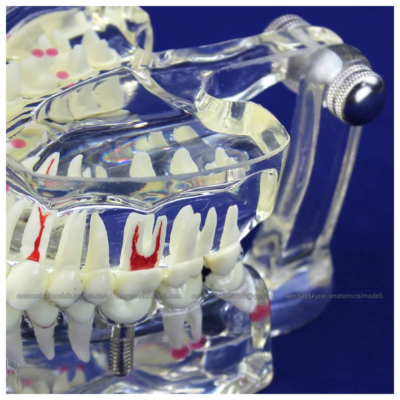 

12567 / Life Size Transparent Dental Model with Implant Tooth, Medical Science Educational Anatomical Models