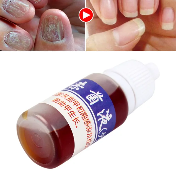 

Nail Treatment Liquid Nourish Antifungal Nails Infection Chinese Herbs Liquid BUTT666