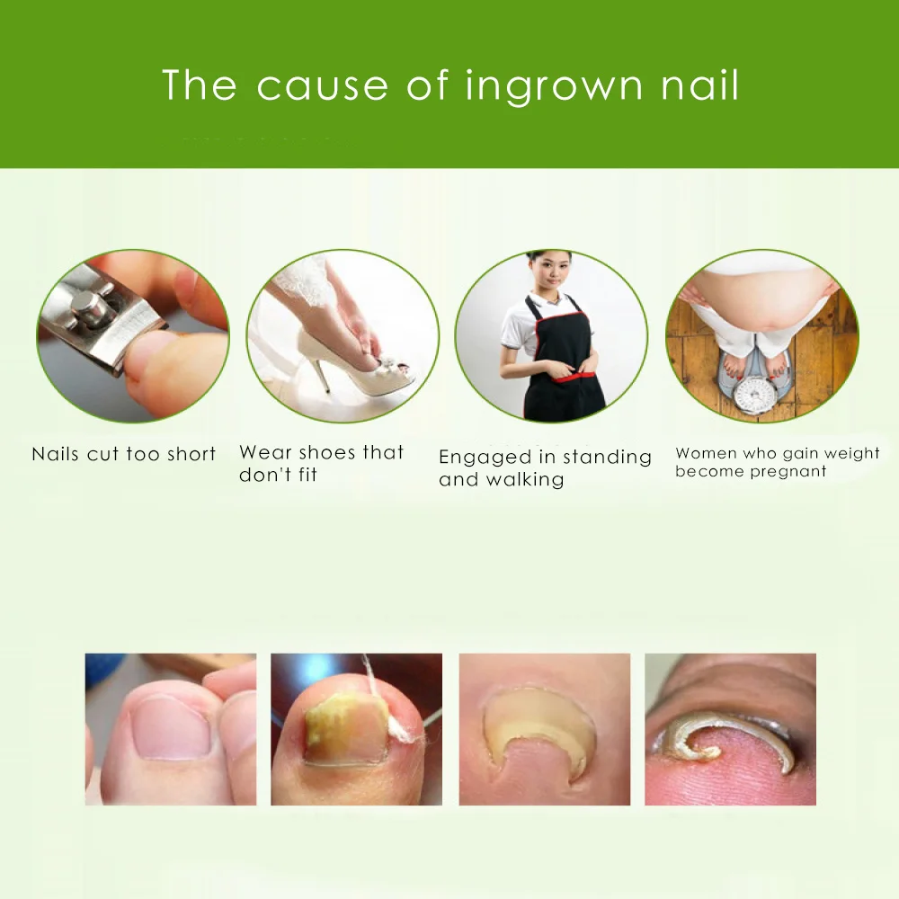 Зажим для выпрямления вросших ногтей изогнутый пластырь BS Brace набор инструментов