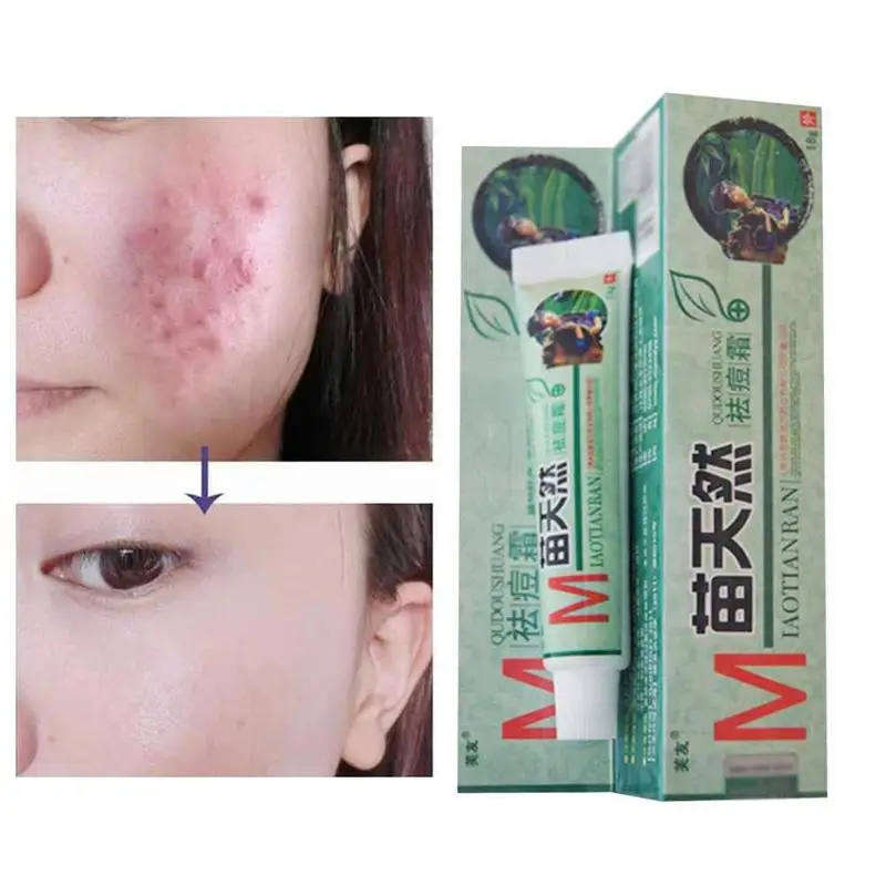 50pcs Fuyou Miaotianran Remove Acne Cream Germicidal Remove Mite and Moisturize Your Skin for Facial Treatment