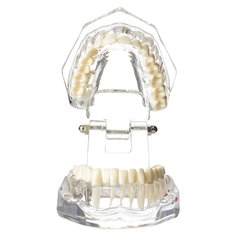 

Dental Model Teeth Implant Restoration Bridge Teaching Study Medical Science Disease Dentist Dentistry Products Dental Gift