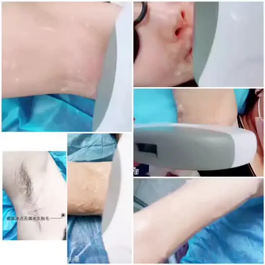 

Лазерный IPL эпилятор OPT Elight, удаление волос, RF омоложение кожи, защита от пигментных веснушек