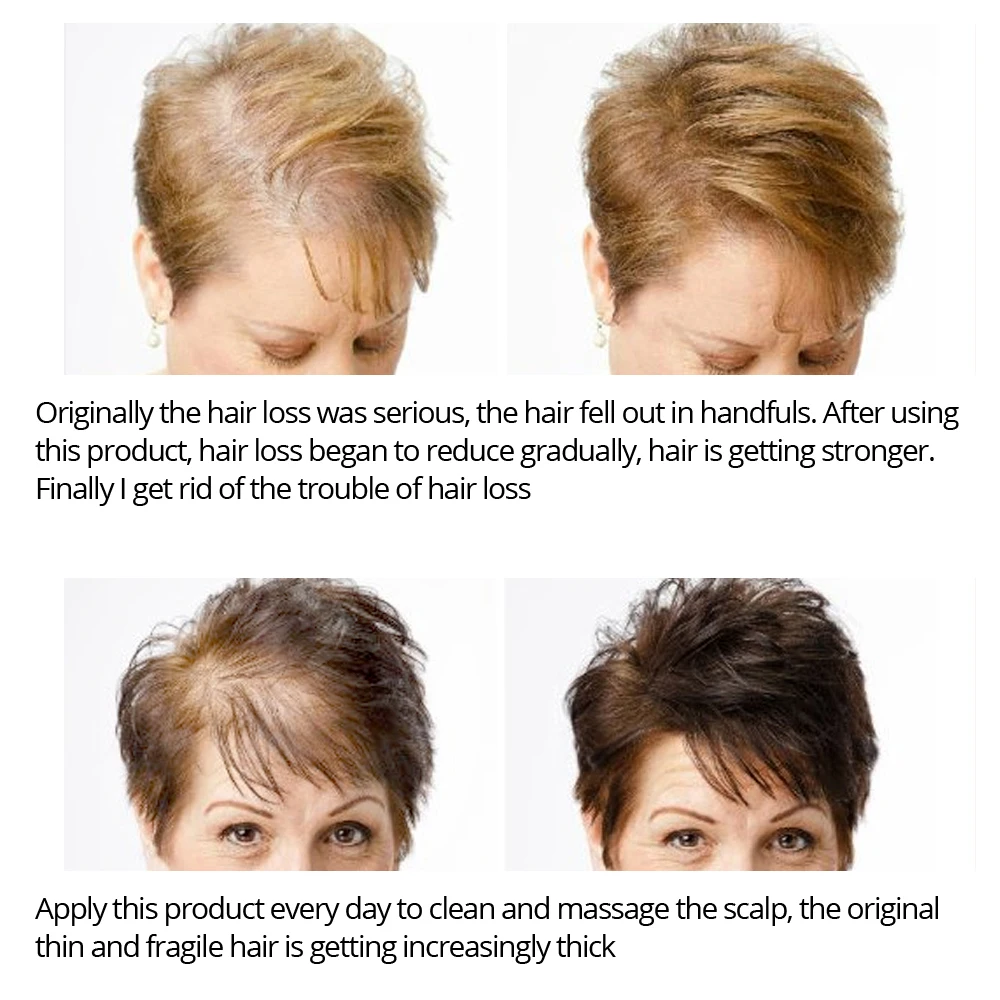 Hair growth promoting essential oil liquid spray nourish the roots of a thick shiny hair loss prevention men and women can | Красота и