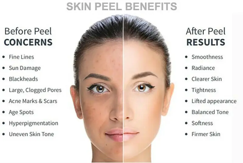 

NEW 2 oz LACTIC Acid Skin Peel- 90% - For: Acne, Scars, Wrinkles, Melasma, Age Spots FREE SHIPPING