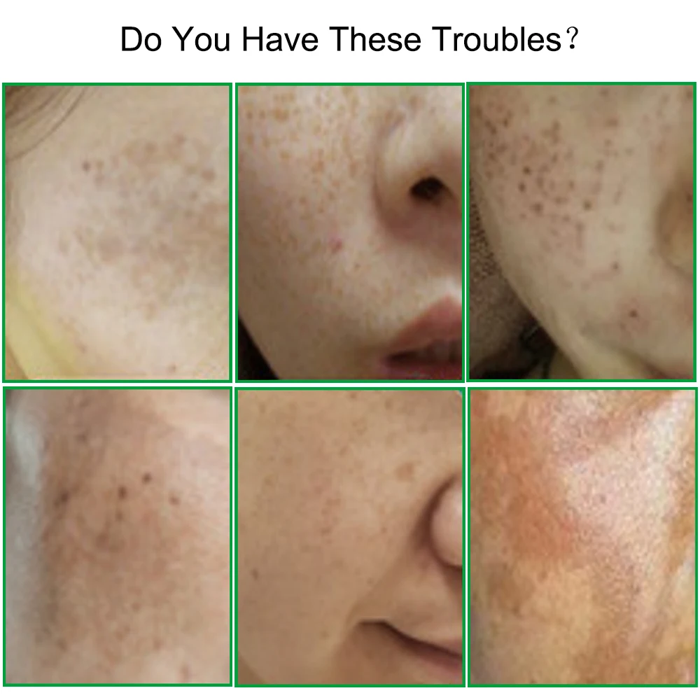 Мгновенное быстрое лечение кожи лица искусственная мелазма пигмент меланин уход