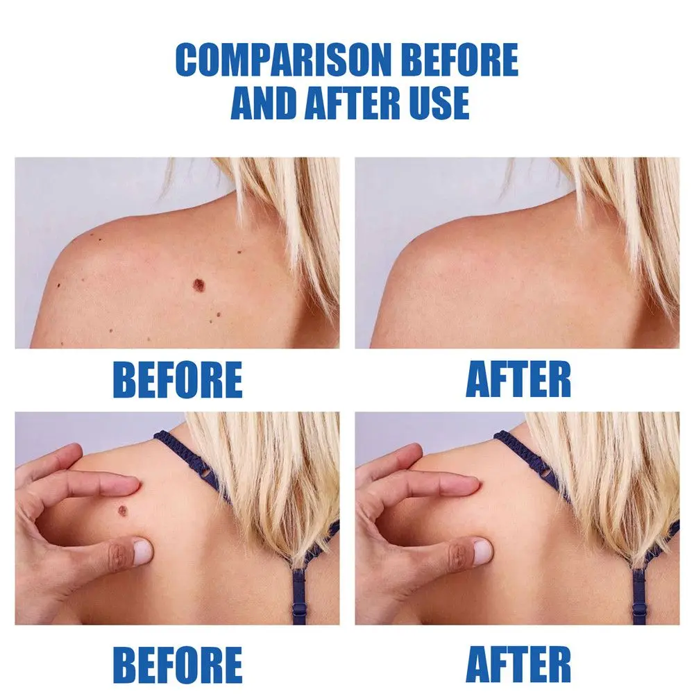 Рисунок 2 - Средство для удаления бородавок с тела