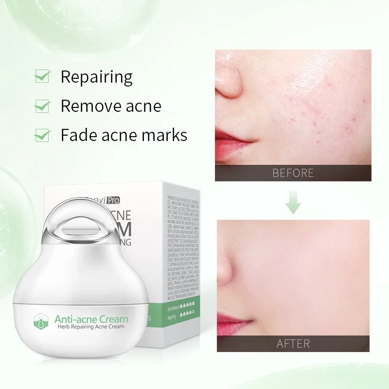 

Fenyi Herbal Anti-acne Cream Acne Removing Acne Moisturizing Whitening Shrink Pores Dilute Acne Cream Skin Care Face Products