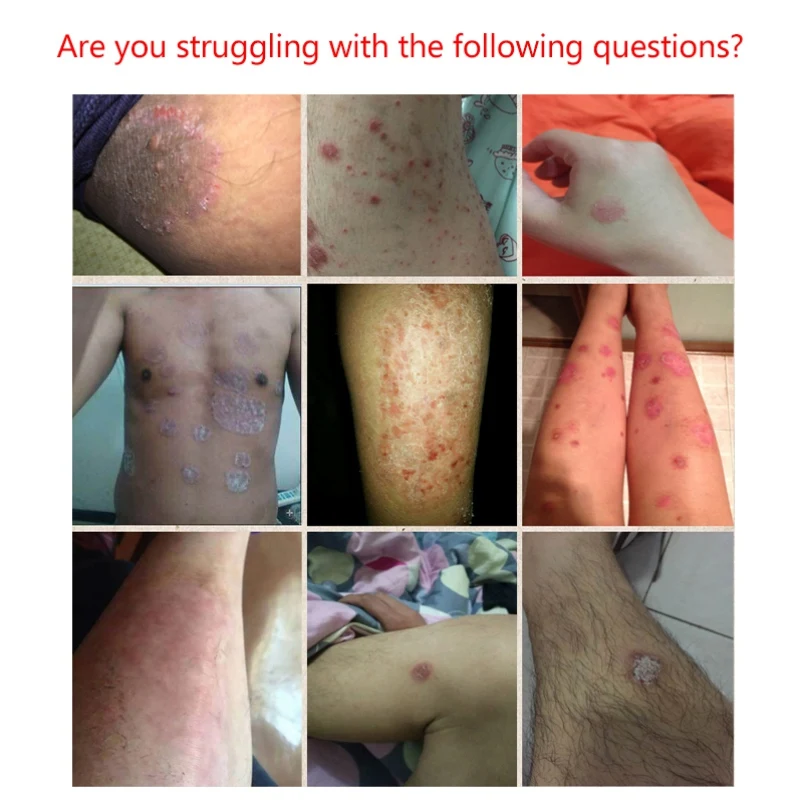 Бактериостатическая мазь для лечения болезней кожи снижает зуд меньше зуда уход