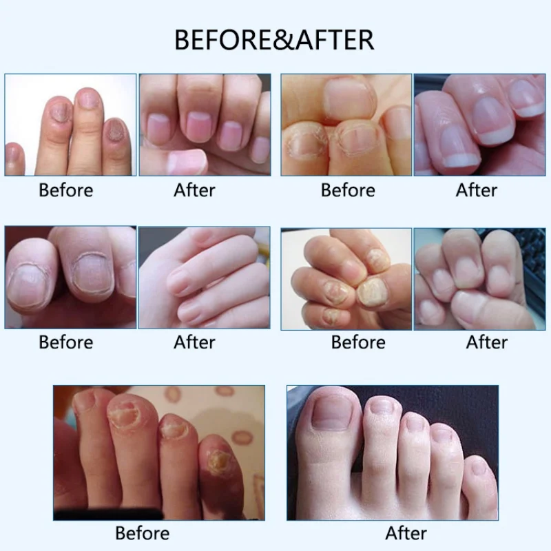 Эффективно против грибка ногтей грибкового раствора для решение Лечение