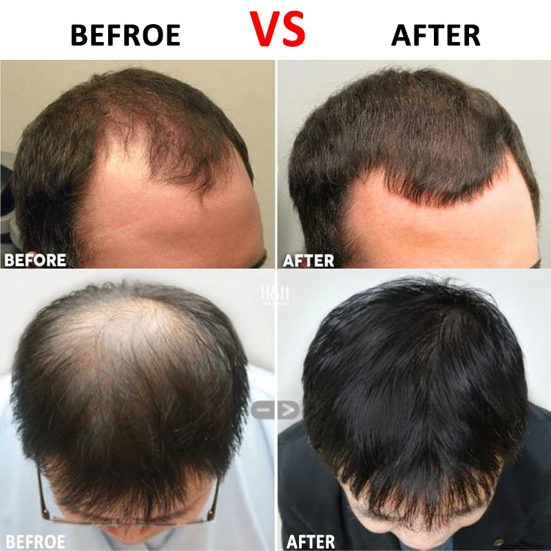 Micro Needle 540 Roller Derma Roller  Dermaroller Titanium Hair Regrowth Beard Growth Anti Hair Loss Treatment Thinning Receding