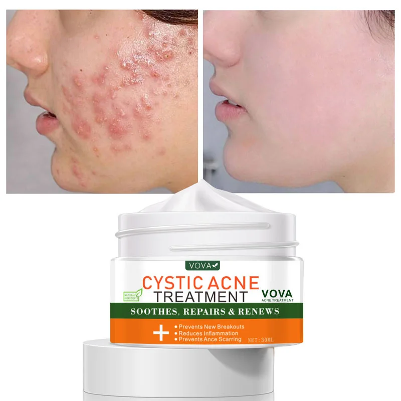 

VOVA Acne Treatment Face Cream Pimple Scar Remover Gel Fade Spots Oil Control Shrink Pores Whitening Moisturizing Skin Care 30g