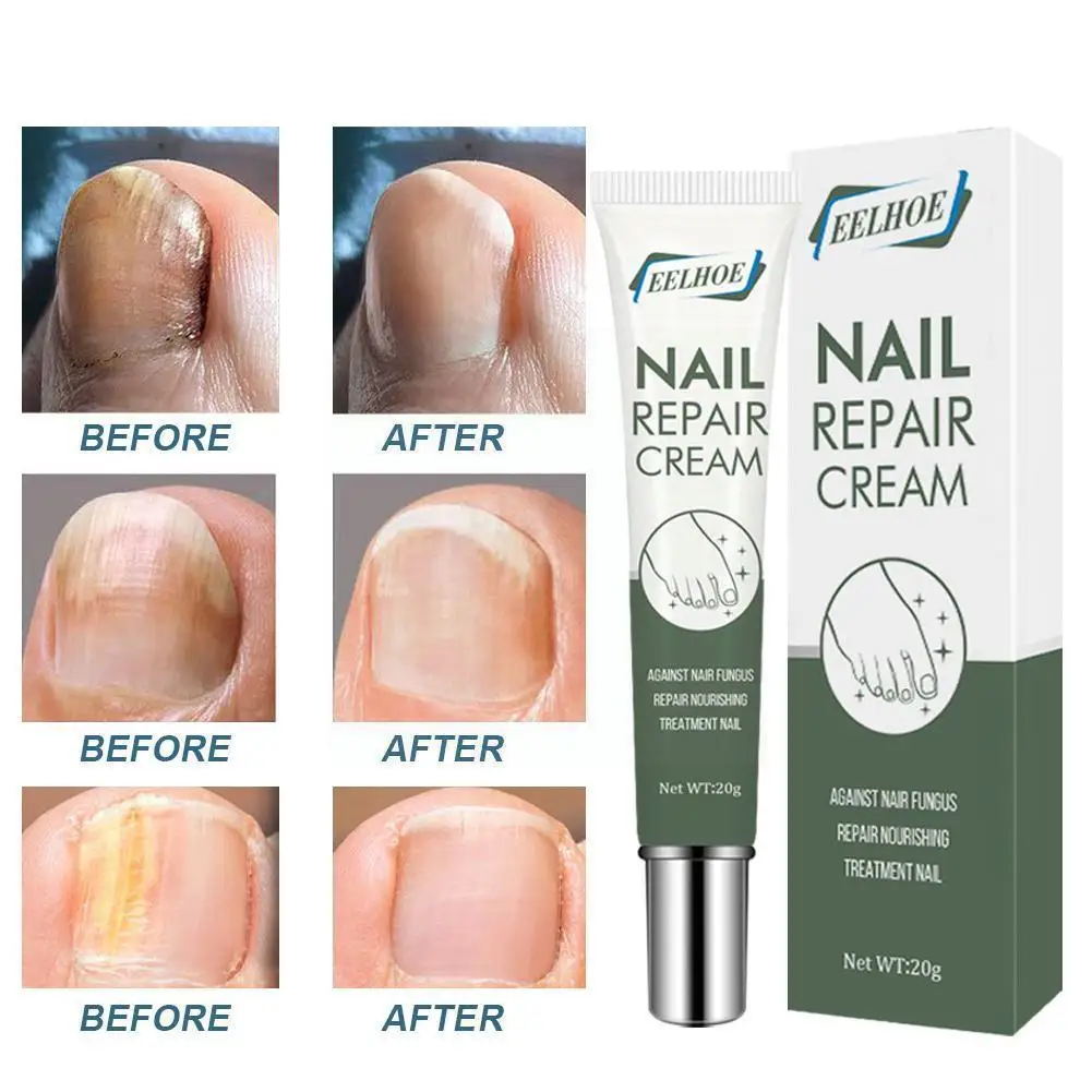 

Fungal Nail Treatment Serum Nail Foot Nail Fungus Removal Repair Onychomycosis Cream Gel Antibacterial Nail Anti Infection A5O6