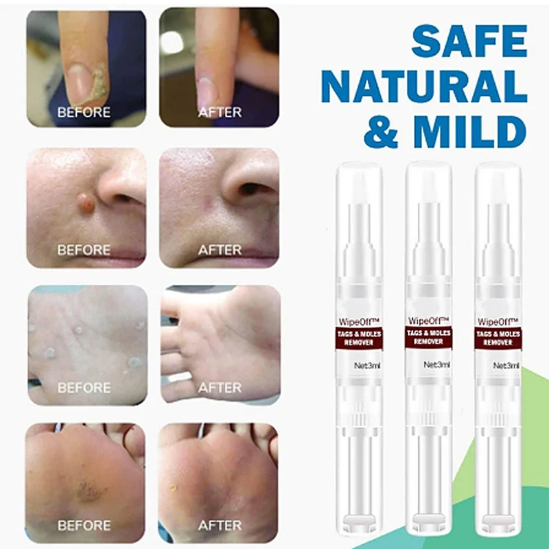 

5ml Clear Moles & Tag Wiper Wipeoff Tags & Moles Remover Liquid Wart Removal Pen Genital Wart Treatment