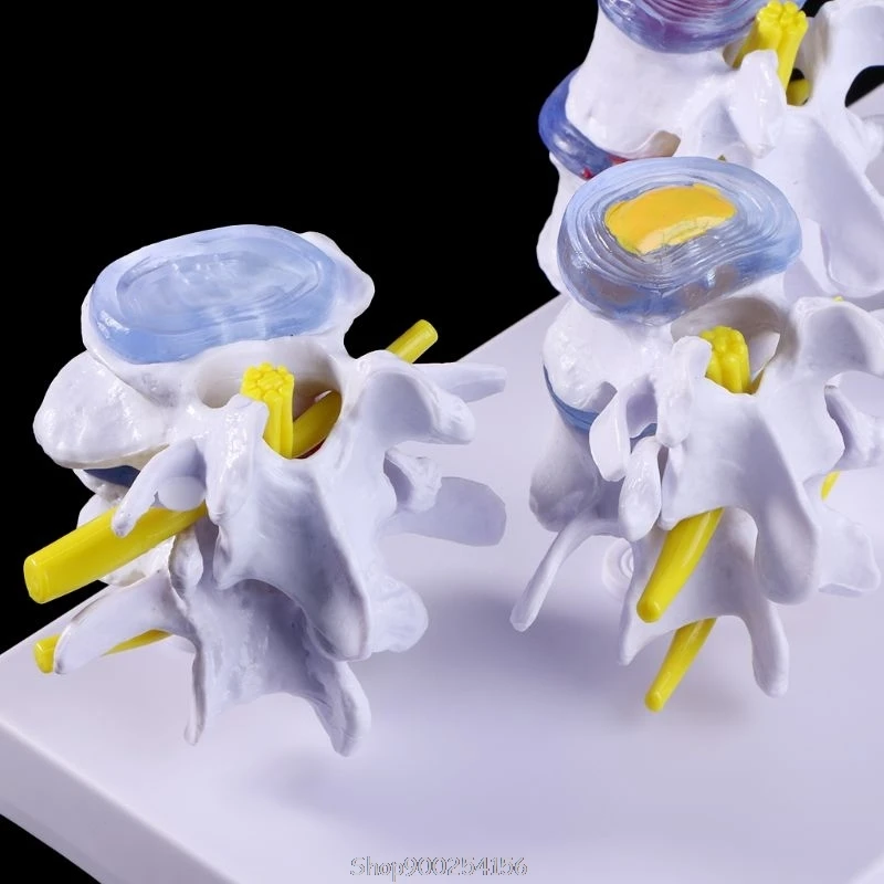 

1 Set Human Lumbar Lesion Spine Statue Display Model Teaching Learning Tool D04 20 Dropship