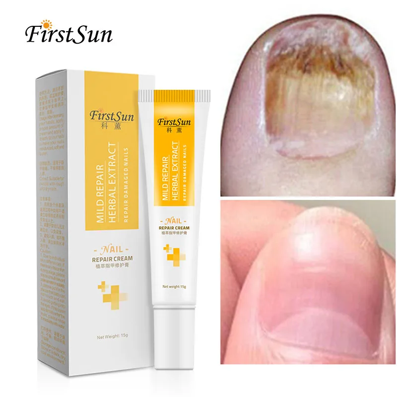 

Fungal Nail Treatment Cream Nail Repair Gel Hand Foot Nail Fungus Treatment Onychomycosis Removal Anti Fungus Nail Repair Care