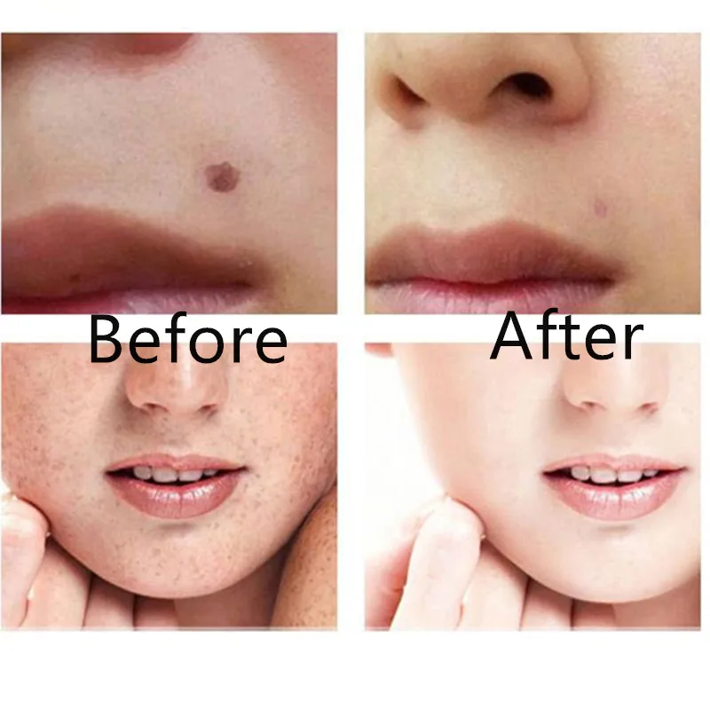 ЖК дисплей плазменной ручка светодиодный освещение татуировки лазера Удаление