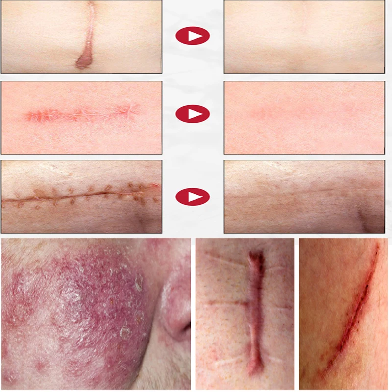 

Scar Cream Face Acne Scar Stretch Marks Remover Cream Scars Surgical Skin Repair Acne Spots Body Care Scar Cream