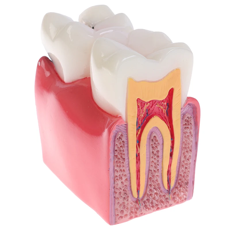

Dental Teeth Model 6 Times Caries Comparation Study Denture Tooth Models