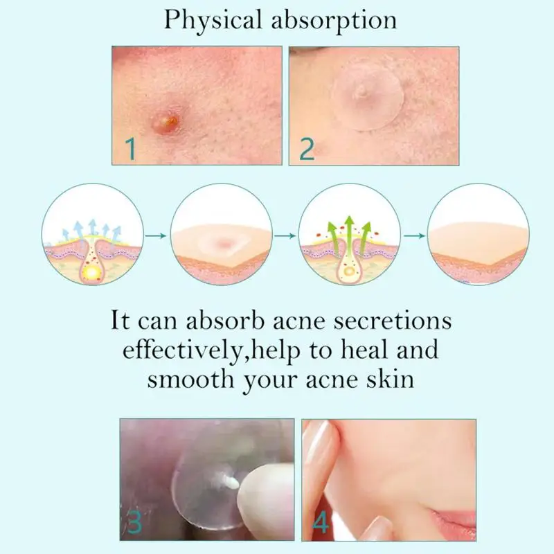 Накладки для прыщей от акне невидимые наклейки лечения маска лица средство