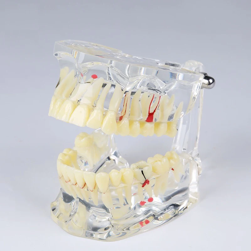 Adult pathological tooth model M4001/Adult pathological  model/Orthodontic pathology demonstration model/Dental teeth model