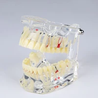 adult pathological tooth model m4001adult pathological modelorthodontic pathology demonstration modeldental teeth model