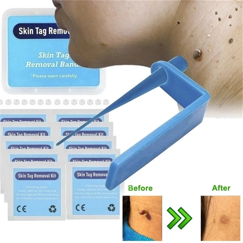 

Medical micro skin tag remover Skin Mole Wart Remover Micro Band Skin Tag Removal Kit With Cleansing Swabs Adult Mole Face Care