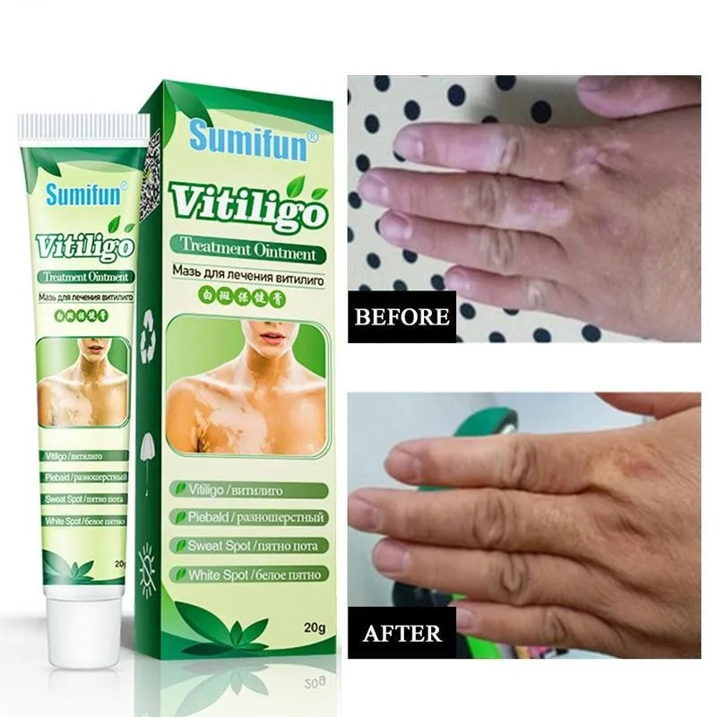 

20g Skin Spot Care And Health Cream Cream Psoriasis Cream 100% Natural Chinese Medicine Antibacterial Effect Prevents Skin Infec