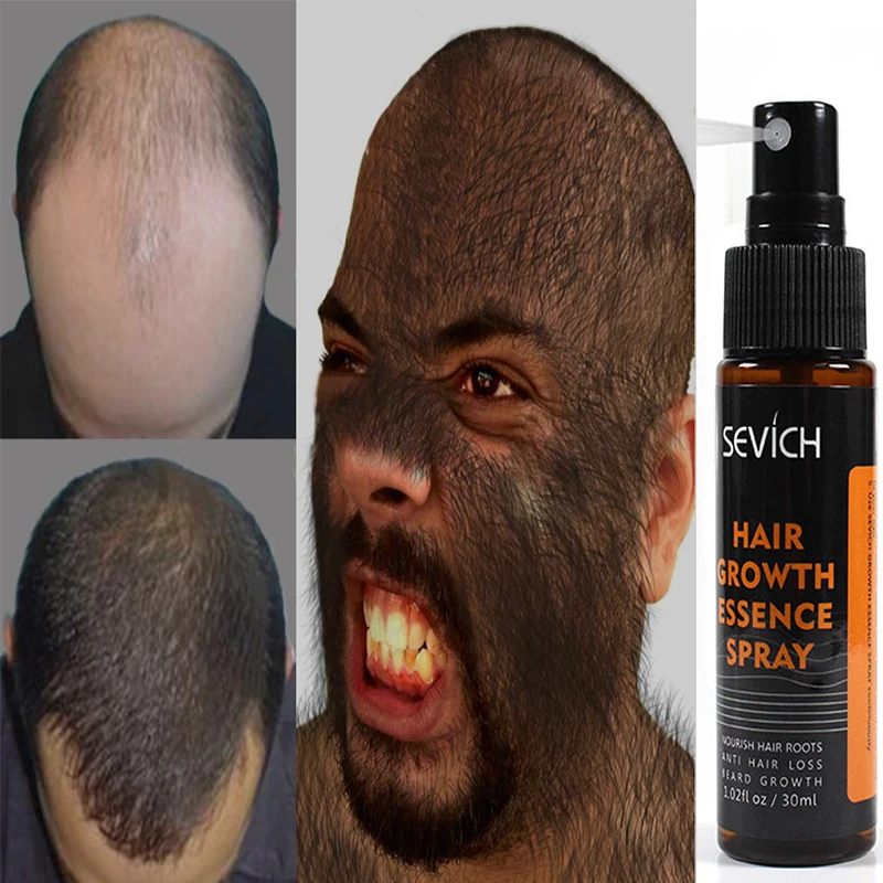 

30ml Sevich Hair Growth Essence Spray Hair loss Treatment Preventing Hair Loss spray hair Growth Essence Hair Care