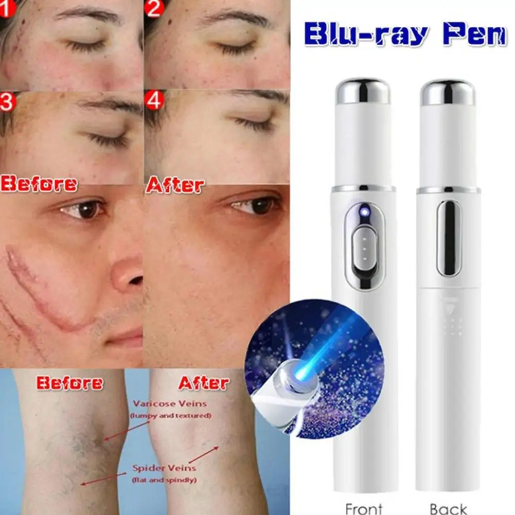 HobbyLane Blu-ray Acne Removing Blue Light Pen Scar Removal Anti Wrinkle Aging Therapy Beauty Device Face Machine Hot | Красота и