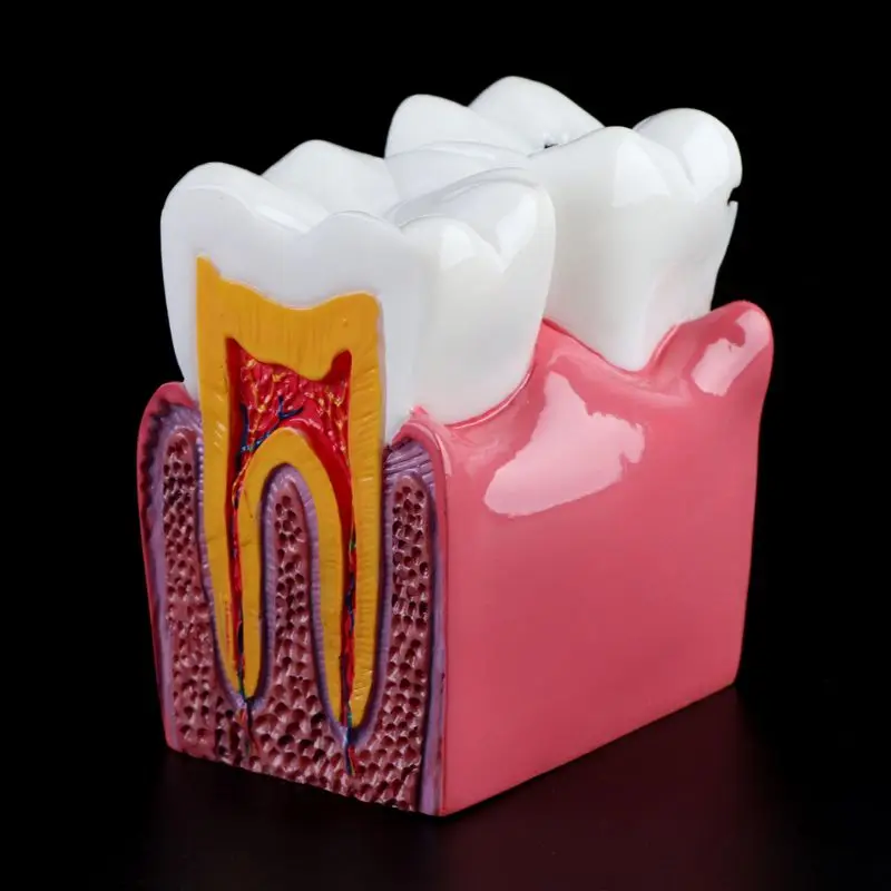 

6 Times Dental Caries Comparation Anatomy Teeth Model for Dental Anatomy Lab Teaching Studying Researching Tool
