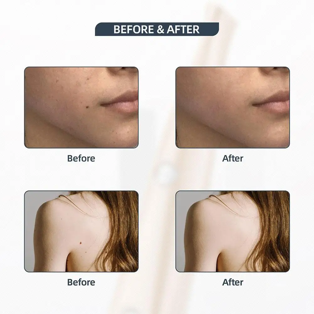 ЖК дисплей плазменной ручка светодиодный освещение машина удаления Уход за