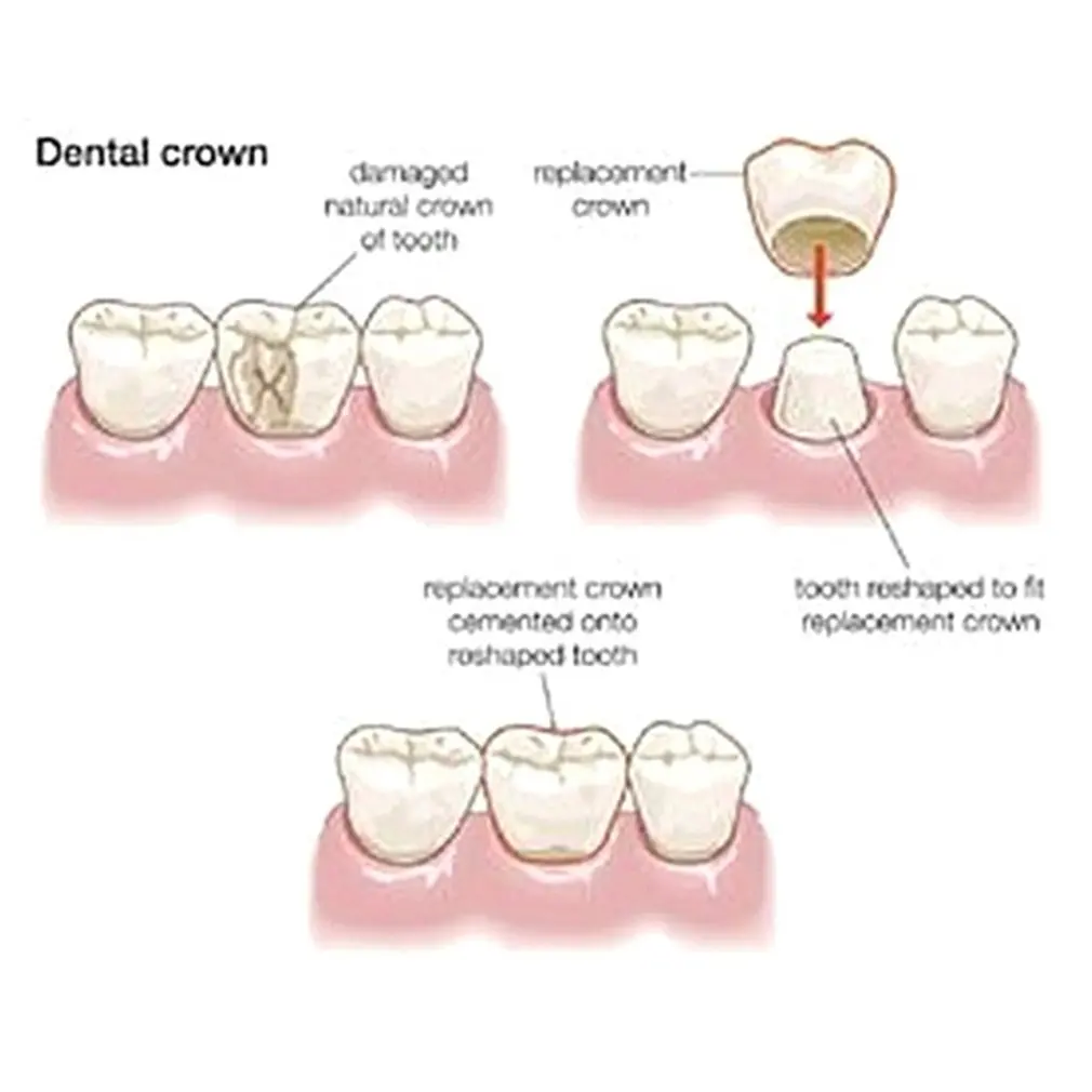 

Porcelain Teeth Temporary Front And Back Teeth Crowns Resin Materials Resin Teeth Care Become Pretty