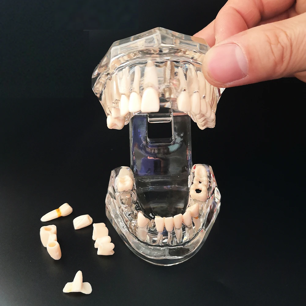 Новинка 2022 Стоматологическая модель реставрационный мост для имплантации зубов