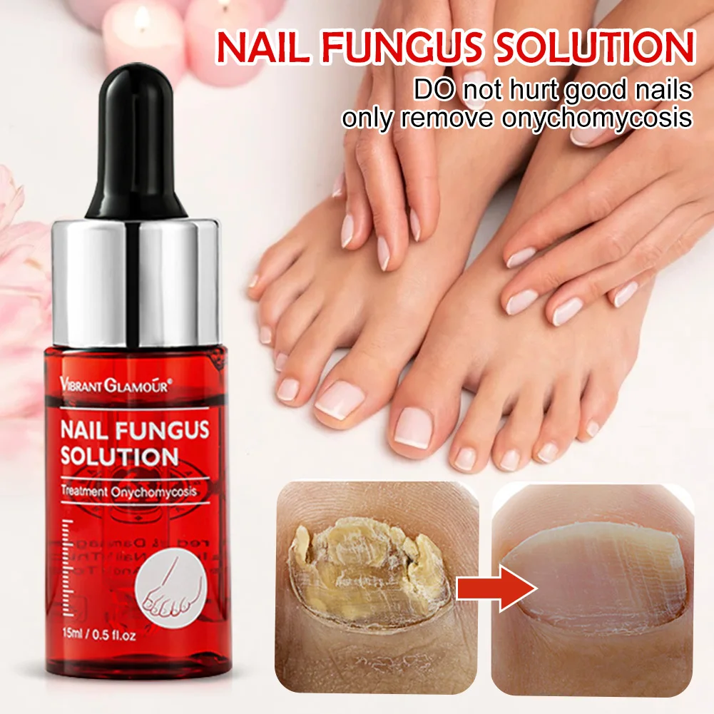 

15ML Nail Fungus Solution Nail Fungus Repair Promote Renewal Fungal Nails Treatment Serum for Fingernails Toenails Nail Toe Care