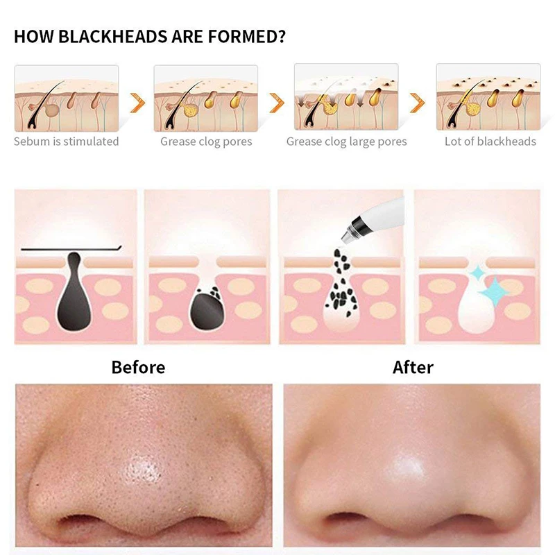 Portable Blackhead Removal Dead Skin Facial Beauty Usb Rechargeable Adjustable Inhalation Lcd Monitor Cleaning Instruments | Красота и