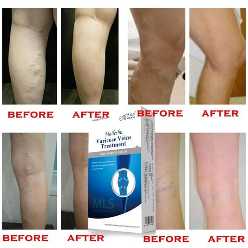 

Лечение Варикозного расширения вен 20 мл