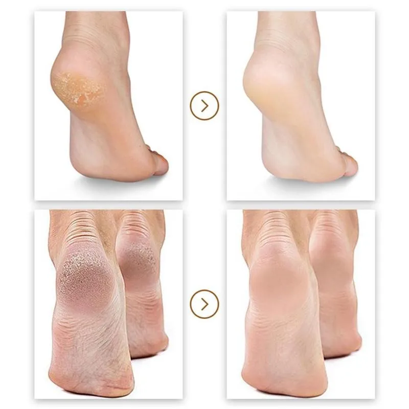 

Foot Care Cream Ointment Corn Removal Pads Warts Thorn Curative Cream Calluses Remove Callosity Detox Professional Foot Cream