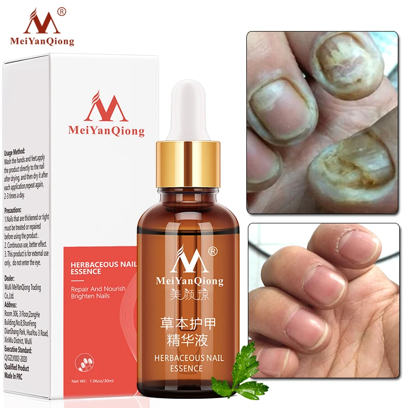 

Fungal Nail Treatment Serum Onychomycosis Paronychia Anti-Fungal Nail Infection Herbal Toe Fungus Foot Repair Essence Care 30ml