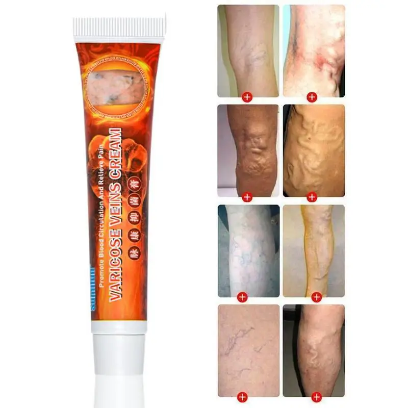 Варикозное расширение вен лечение крем мазь васкулит флебит ангиит воспаление